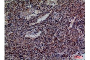 Immunohistochemistry (IHC) analysis of paraffin-embedded Human Lung Cancer, antibody was diluted at 1:100. (CD48 anticorps  (Internal Region))
