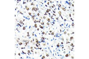 Immunohistochemistry of paraffin-embedded human liver cancer using CRM1/XPO1 antibody (ABIN7267067) at dilution of 1:100 (40x lens). (XPO1 anticorps)