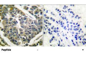 Immunohistochemical analysis of paraffin-embedded human breast carcinoma tissue using COL4A1 polyclonal antibody . (COL4A1 anticorps  (AA 31-70))
