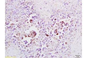 Formalin-fixed and paraffin embedded mouse lymphoma tissue labeled with Anti-Cyclin A2 Polyclonal Antibody , Unconjugated at 1:100, followed by conjugation to the secondary antibody and DAB staining (Cyclin A anticorps  (AA 375-431))