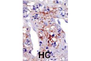Formalin-fixed and paraffin-embedded human hepatocellular carcinoma tissue reacted with PIP5K1C polyclonal antibody  , which was peroxidase-conjugated to the secondary antibody, followed by AEC staining. (PIP5K1C anticorps  (N-Term))