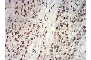Immunohistochemical analysis of paraffin-embedded esophageal cancer tissues using ANAPC10 mouse mAb with DAB staining. (ANAPC10 anticorps  (AA 1-185))