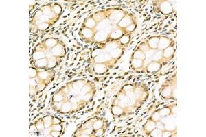 Immunohistochemistry of paraffin embedded human colon cancer using PABPN1 (ABIN7075116) at dilution of 1:600 (400x lens) (PABPN1 anticorps)