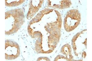 Formalin-fixed, paraffin-embedded human Breast Carcinoma stained with GRP94 Rat Monoclonal Antibody (9G10. (GRP94 anticorps)