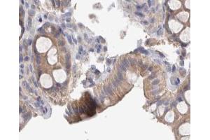 ABIN6267374 at 1/200 staining human colon cancer tissue sections by IHC-P. (Src anticorps  (pTyr419))