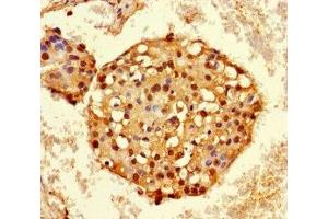 Immunohistochemistry of paraffin-embedded human breast cancer using ABIN7155138 at dilution of 1:100 (HNRNPA2B1 anticorps  (AA 1-249))