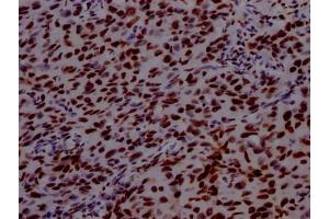 IHC image of ABIN7127661 diluted at 1:100 and staining in paraffin-embedded human bladder cancer performed on a Leica BondTM system.
