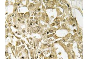 Immunohistochemistry analyzes of Catenin-β antibody in paraffin-embedded human breast carcinoma tissue. (CTNNB1 anticorps)