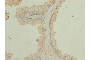 Immunohistochemistry of paraffin-embedded human prostate cancer using ABIN7176044 at dilution of 1:100
