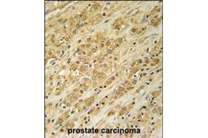 DKC1 Antibody immunohistochemistry analysis in formalin fixed and paraffin embedded human prostate carcinoma followed by peroxidase conjugation of the secondary antibody and DAB staining. (DKC1 anticorps  (AA 185-213))