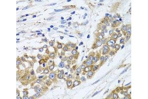 Immunohistochemistry of paraffin-embedded Human colon carcinoma using PEX14 Polyclonal Antibody at dilution of 1:100 (40x lens). (PEX14 anticorps)