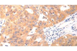 Immunohistochemistry of paraffin-embedded Human ovarian cancer using CAPNS1 Polyclonal Antibody at dilution of 1:60