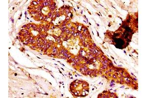 IHC image of ABIN7152610 diluted at 1:100 and staining in paraffin-embedded human breast cancer performed on a Leica BondTM system.