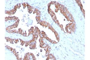 Formalin-fixed, paraffin-embedded human Prostate Carcinoma stained with PMEPA1 Mouse Monoclonal Antibody (PMEPA1/2696). (PMEPA1 anticorps)