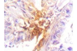 Immunohistochemistry analyzes of IL-2Rβ antibody in paraffin-embedded human lung carcinoma tissue. (IL2 Receptor beta anticorps)