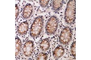 Immunohistochemical analysis of IL-12B staining in human colon cancer formalin fixed paraffin embedded tissue section. (IL12B anticorps  (C-Term))