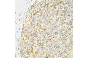 Immunohistochemistry of paraffin-embedded human liver cancer using PPP1CA antibody (ABIN6290760) at dilution of 1:100 (40x lens). (PPP1CA anticorps)