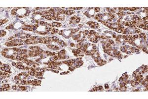 ABIN6272414 at 1/100 staining Human liver cancer tissue by IHC-P. (RHOG anticorps  (Internal Region))