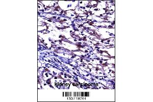 TNFRSF11B Antibody immunohistochemistry analysis in formalin fixed and paraffin embedded human kidney carcinoma followed by peroxidase conjugation of the secondary antibody and DAB staining.