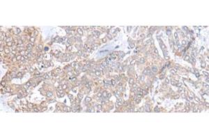 Immunohistochemistry of paraffin-embedded Human liver cancer tissue using PLGLB2 Polyclonal Antibody at dilution of 1:65(x200) (PLGLB2 anticorps)
