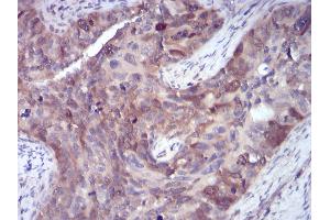 Immunohistochemical analysis of paraffin-embedded human cervical cancer tissues using SELL mouse mAb with DAB staining. (L-Selectin anticorps  (AA 83-186))