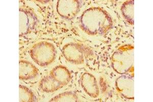 Immunohistochemistry of paraffin-embedded human gastric cancer using ABIN7173760 at dilution of 1:100 (TDRD1 anticorps  (AA 12-314))