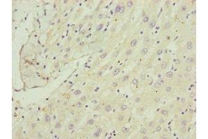 Immunohistochemistry of paraffin-embedded human liver cancer using ABIN7148370 at dilution of 1:100