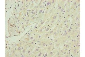 Immunohistochemistry of paraffin-embedded human liver cancer using ABIN7148370 at dilution of 1:100 (C8B anticorps  (AA 55-350))