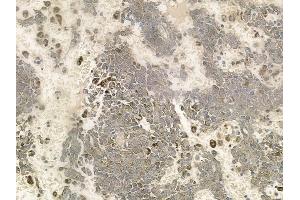 ABIN6263948 and ABIN6272736 at 1/100 staining human melanoma by IHC-P.
