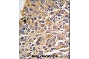 Formalin-fixed and paraffin-embedded human lung carcinoma tissue reacted with RIP3 (RIPK3) antibody (N-term) (ABIN391272 and ABIN2841322) , which was peroxidase-conjugated to the secondary antibody, followed by DAB staining.