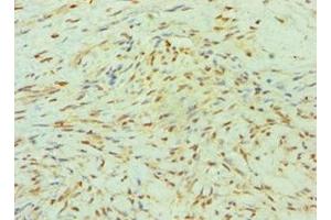 Immunohistochemistry of paraffin-embedded human breast cancer using ABIN7155524 at dilution of 1:100