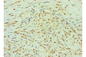Immunohistochemistry of paraffin-embedded human breast cancer using ABIN7155524 at dilution of 1:100 (SMYD3 anticorps  (AA 199-428))