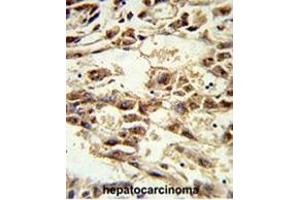 Formalin-fixed and paraffin-embedded human hepatocarcinoma reacted with AIFM2 Antibody (C-term), which was peroxidase-conjugated to the secondary antibody, followed by DAB staining.