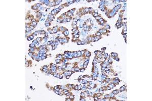 Immunohistochemistry of paraffin-embedded Human thyroid cancer using IL23R Rabbit pAb (ABIN3022245, ABIN3022246, ABIN3022247, ABIN1513088 and ABIN6218691) at dilution of 1:100 (40x lens). (IL23R anticorps  (AA 405-629))