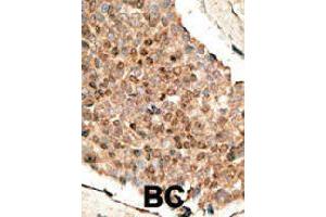 Formalin-fixed and paraffin-embedded human cancer tissue reacted with BMP10 polyclonal antibody  , which was peroxidase-conjugated to the secondary antibody, followed by DAB staining. (BMP10 anticorps  (N-Term))
