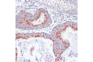 Immunohistochemistry of paraffin-embedded human colon carcinoma using CD71/Transferrin Receptor antibody (ABIN6131555, ABIN6149065, ABIN6149066 and ABIN6221572) at dilution of 1:100 (40x lens). (Transferrin Receptor anticorps  (AA 1-140))