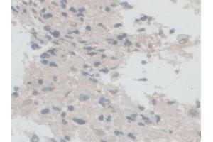 Detection of NOX5 in Human Glioma Tissue using Polyclonal Antibody to Nicotinamide Adenine Dinucleotide Phosphate Oxidase 5 (NOX5)