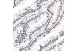 Immunohistochemistry of paraffin-embedded human colon carcinoma using [KO Validated] TMPO Rabbit pAb (ABIN3016206, ABIN3016207, ABIN3016208, ABIN1683056 and ABIN1683057) at dilution of 1:25 (40x lens).