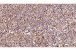 ABIN6273194 at 1/100 staining Human lymph cancer tissue by IHC-P. (ARL8B anticorps  (Internal Region))