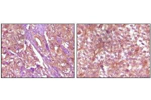 Immunohistochemical analysis of paraffin-embedded Human pancreas carcinoma (left) and breast carcinoma (right) tissue, showing membrane and cytoplasmic (pancreas carcinoma) localization, membrane (breast carcinoma) localization using EphB4 mouse mAb with DAB staining.