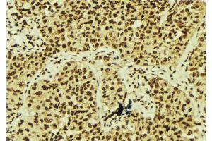 ABIN6268656 at 1/100 staining Human breast cancer tissue by IHC-P. (XBP1 anticorps  (C-Term))