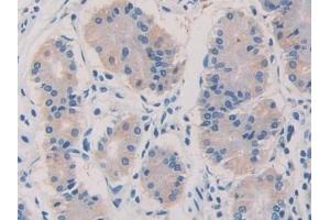 Detection of F5 in Human Stomach cancer Tissue using Polyclonal Antibody to Coagulation Factor V (F5)