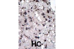 Formalin-fixed and paraffin-embedded human hepatocellular carcinoma tissue reacted with HK2 polyclonal antibody  , which was peroxidase-conjugated to the secondary antibody, followed by DAB staining. (Hexokinase 2 anticorps  (Internal Region))