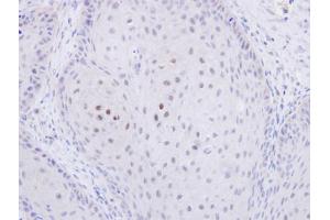 IHC-P Image Immunohistochemical analysis of paraffin-embedded Cal27 xenograft, using C20orf11, antibody at 1:500 dilution. (GID8/C20orf11 anticorps  (Center))