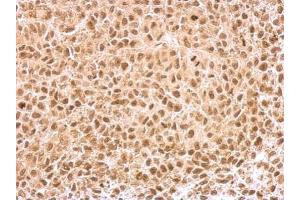 IHC-P Image KLF5 antibody detects KLF5 protein at nucleus on HeLa xenograft by immunohistochemical analysis.