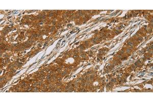 Immunohistochemistry of paraffin-embedded Human gasrtic cancer tissue using CYP27A1 Polyclonal Antibody at dilution 1:50