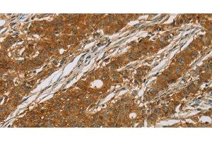 Immunohistochemistry of paraffin-embedded Human gasrtic cancer tissue using CYP27A1 Polyclonal Antibody at dilution 1:50 (CYP27A1 anticorps)