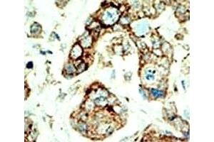 IHC analysis of FFPE human breast carcinoma tissue stained with the EphA2 antibody (EPH Receptor A2 anticorps  (AA 30-60))