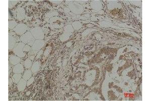Immunohistochemistry (IHC) analysis of paraffin-embedded Human Breast Carcinoma using Pan Methylated Lysine Monoclonal Antibody. (Methylated Lysine (pan) anticorps)