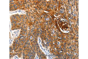 Immunohistochemistry of Human esophagus cancer using AQP5 Polyclonal Antibody at dilution of 1:40 (Aquaporin 5 anticorps)